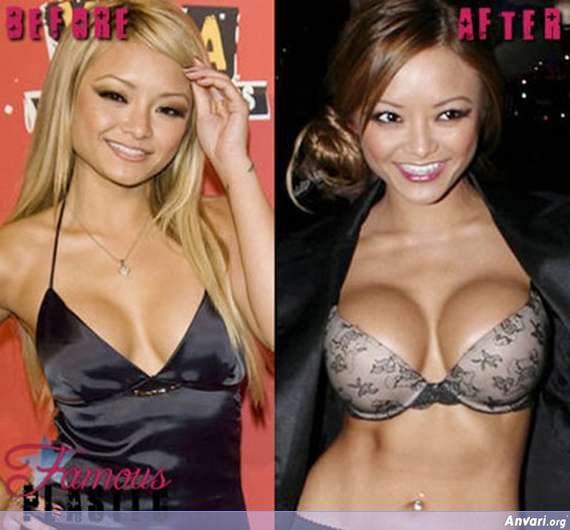 Breast Enlargement 10 - Stars with Breast Enhancement 